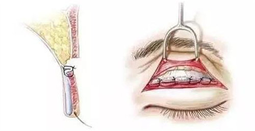 全切雙眼皮動(dòng)畫(huà)圖