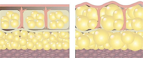脂肪膨胀对比图