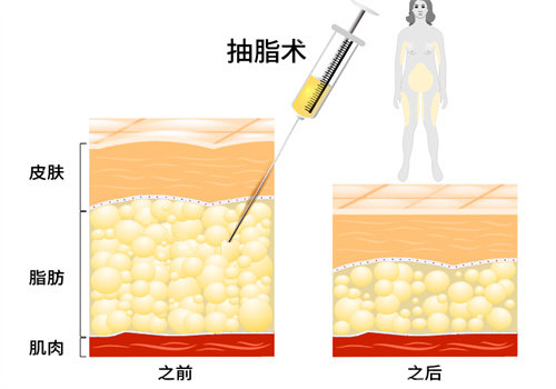 抽脂術(shù)說明圖