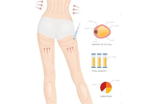 全身抽脂详解图