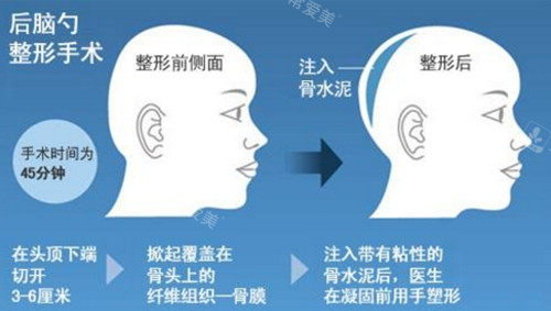 骨水泥填充后腦勺 骨水泥填充后腦勺