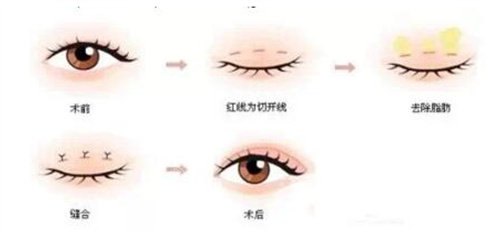 全切双眼皮流程图 全切双眼皮流程图