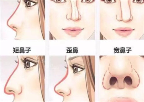 鼻部形态展示图 鼻部形态展示图