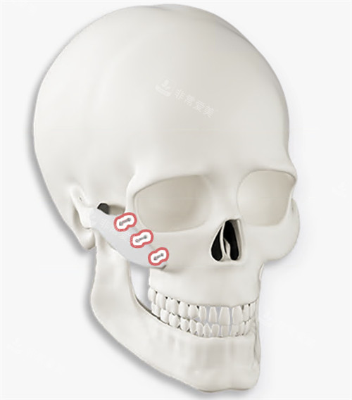 韩国绮林整形外科颧骨固定方式