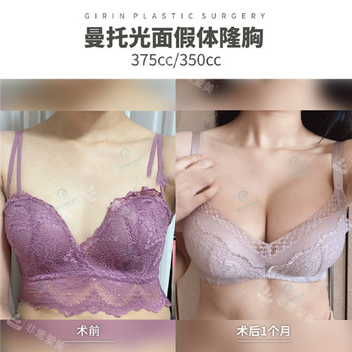 韓國(guó)綺林整形外科隆胸手術(shù)對(duì)比照