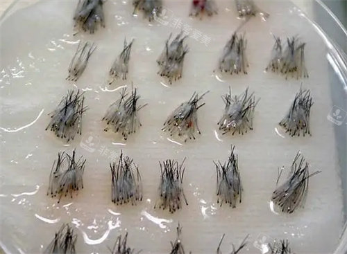 毛囊处理图片 毛囊处理图片