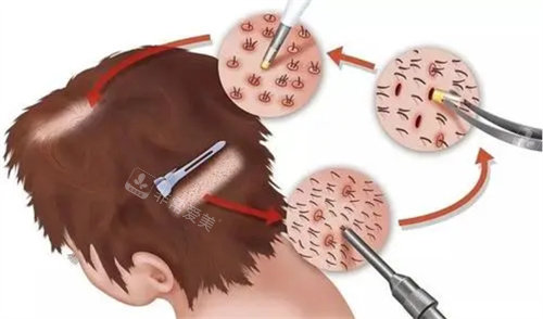 毛发移植手术过程图