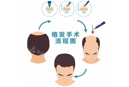 植發(fā)手術(shù)說明圖
