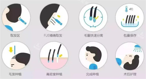 植發(fā)流程說明圖