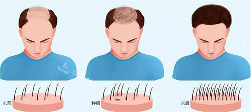男性植發(fā)前后對比圖