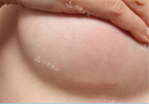 韩国格瑞丝噢爱美整形隆胸术后疤痕