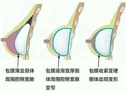 包膜挛缩变化过程图