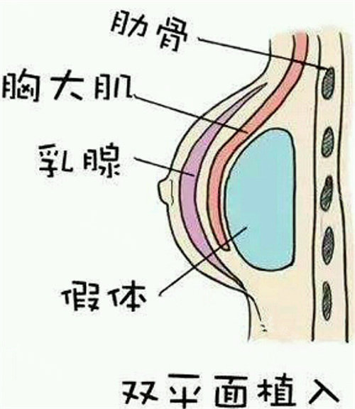 假体隆胸图