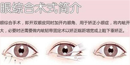 眼綜合術(shù)式簡介 眼綜合術(shù)式簡介