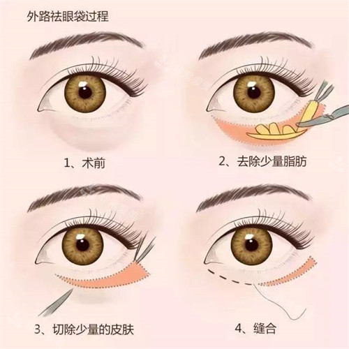 祛眼袋手术过程图