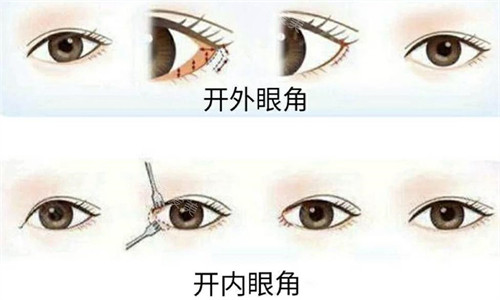 開內(nèi)、外眼角手術(shù)過程圖 開內(nèi)、外眼角手術(shù)過程圖