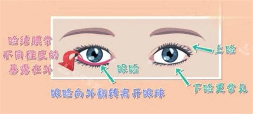 祛眼袋手術(shù)失敗癥狀示意圖 祛眼袋手術(shù)失敗癥狀示意圖