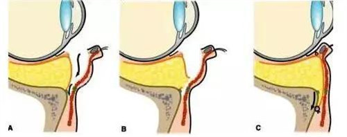 下睑外翻手术过程示意图