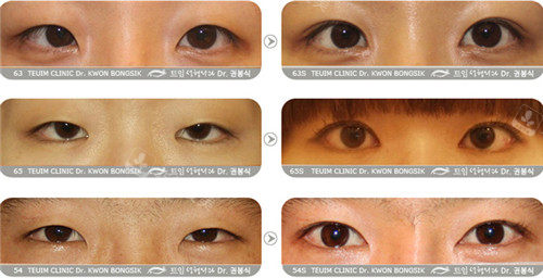 韩国特艺整形做双眼皮图片