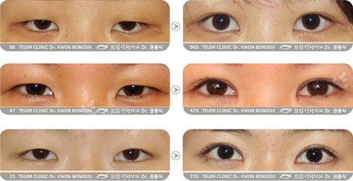 韩国特艺整形做眼睑下垂矫正图