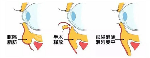 眼底脂肪重排手術(shù)過程示意圖