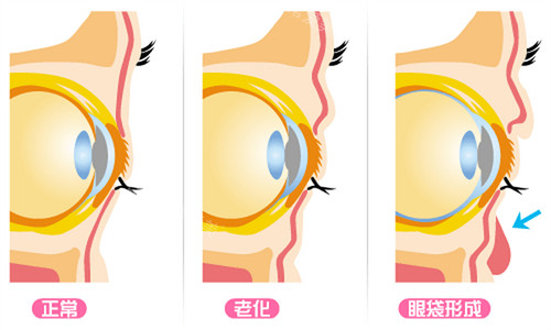 眼袋形成過程示意圖