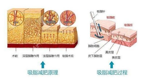 吸脂原理示意圖