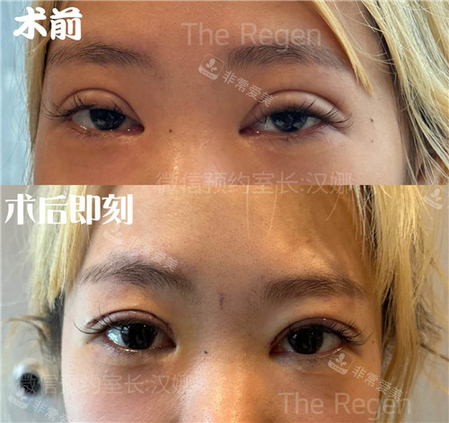 韓國JN整容外科眼修復(fù)對比照