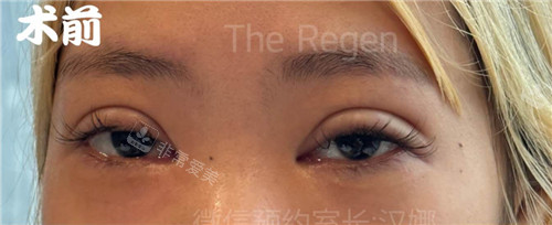韩国德丽珍整容外科眼修复术前照片