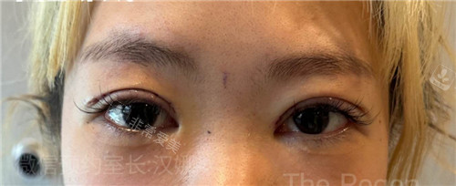 韩国德丽珍整容外科双眼皮修复术后即刻图