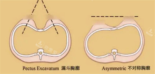 胸廓形态展示图