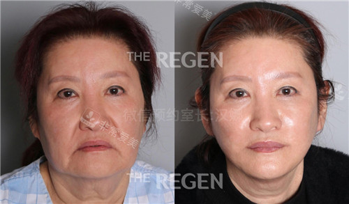 韩国德丽珍整形外科拉皮手术对比照