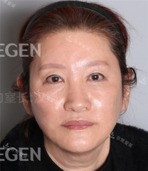 韩国德丽珍整形外科拉皮手术术后图
