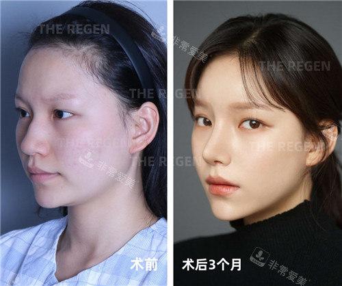 韓國德麗珍整容外科輪廓+鼻綜合手術對比照