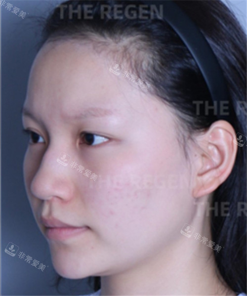 韩国德丽珍整容外科轮廓+鼻综合手术术前图