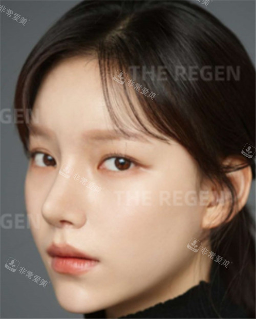 韓國德麗珍整容外科輪廓+鼻綜合手術術后圖