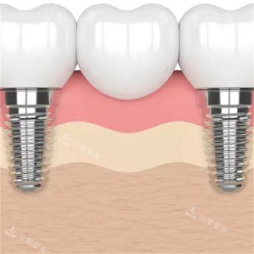 种植牙示意图