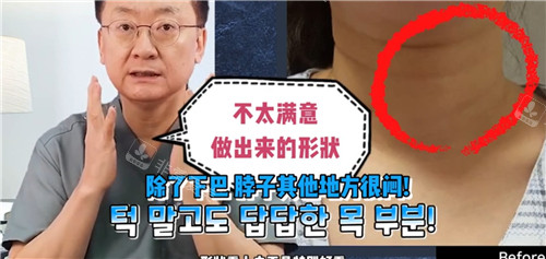 單純做雙下巴手術(shù)術(shù)后形態(tài)展示