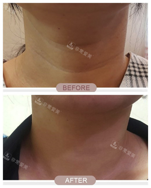 韩国延世多仁整形外科颈纹改善对比照