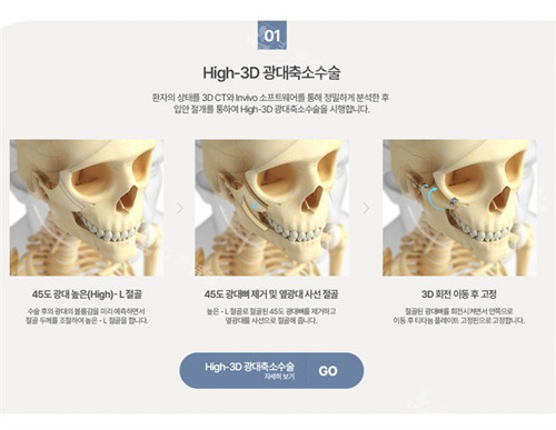  韓國1%整形外科顴骨整形術(shù)式