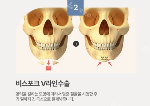  韓國1%整形外科下巴整形術(shù)式展示