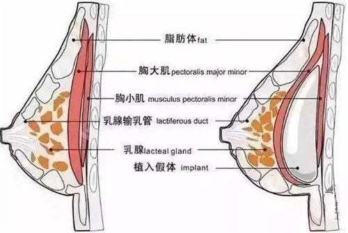 假體隆胸圖