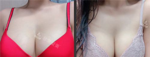 韩国水滴整形外科隆胸术后图