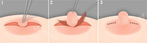 胸部缩小术过程图