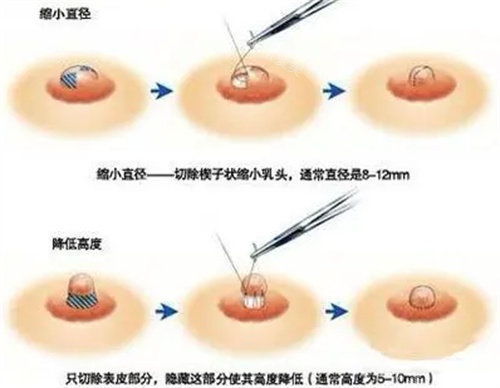 胸部缩小手术操作图