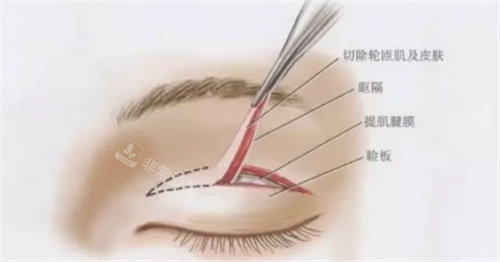 双眼皮手术展示图 双眼皮手术展示图