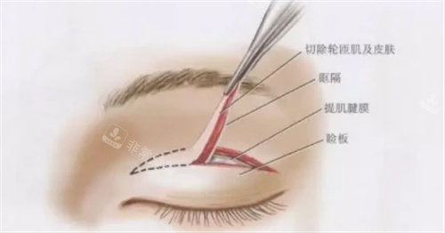 双眼皮手术展示图