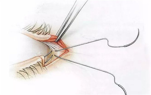开眼角缝合图