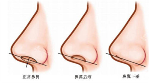 正常鼻翼与下垂鼻翼展示图