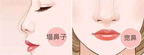 塌鼻子與寬鼻展示圖